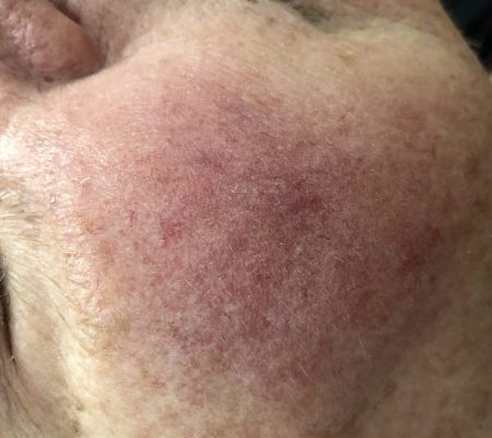 (1-1) ROSACEA